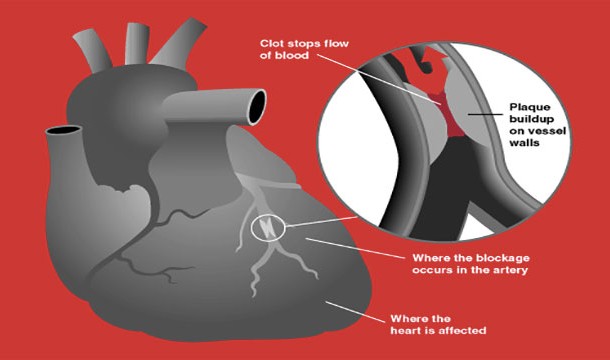 During heart attacks, males experience the "classic" symptoms like chest and jaw pain, while for females the symptoms can be quite diverse. In fact, it can often be confused for heart burn.