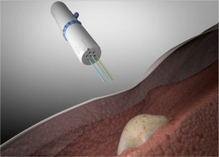 CIVO.
CIVO is a device that allows test drugs to be simultaneously delivered into specific areas within a living tumor. The hand-held device is a microinjection procedure that consists of needles positioned to deliver drugs into up to eight different tissue depths within a tumor. With this, doctors can tell very quickly what treatment will be the best for each individual patient.