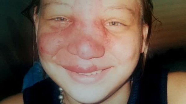 The 'Birthmark' Expands.
At 8, Jennifer's 'birthmark' began to expand. The mass between her eyes and upper lip also grew, and the family still didn't have answers. She underwent a series of laser surgeries and continued to lose blood.