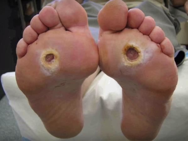 Jiggers.
A jigger is a small measuring device often used by baristas or bartenders. Jiggers, however, are small chigoe fleas that you can find in dust or in rural areas. If you are infected, it isn't pretty. Infection can lead to inflammation or turn as serious as death.