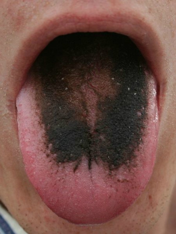 This condition sounds (and looks) a lot worse than it is. After all, it doesn't do any harm and usually goes away without any medical treatment. Even so, it's pretty disturbing for your tongue to become black and fuzzy. Also, having a constant metallic taste in your mouth and bad breath isn't exactly pleasant. A prescription medication doesn't even cause this condition, but an over the counter upset stomach treatment does — Pepto Bismol. Pepto can also make your feces black, so you can have both ends of your digestive system look equally disturbing — all thanks to one fun treatment.
