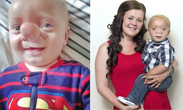 A Welsh toddler has been described as a “real-life Pinocchio” after a rare condition left him with a bulbous nose. Twenty-one-month-old Ollie Trezise was born with encephalocele, a birth defect which caused his brain to grow through a crack in his skull into his nose. Ollie has undergone several painful surgeries at Birmingham Children's Hospital to enable him to breathe.

His mother first discovered something was different about Ollie when doctors spotted an unexpected soft tissue growing on his face during her 20-week scan. An MRI later confirmed that the lump on the boy's nose was encephalocele. It happens when the neural tube does not close completely during pregnancy, leaving an opening in the midline of the upper part of the skull, the area between the forehead and nose, or the back of the skull, according to the Centers for Disease Control and Prevention.