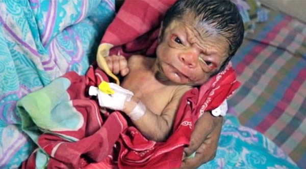 A newborn baby boy has been dubbed Bangladesh's Benjamin Button due to his resemblance to an elderly man resulting from a rare genetic disorder, known as progeria, which affects one in 8 million births.

The boy has a wrinkled forehead, sunken eyes, and a shrunken body, sparking comparisons to the Hollywood film and F. Scott Fitzgerald story, The Curious Case of Benjamin Button, which depicts a baby born looking like an old man who then ages in reverse. He was born in the village of Bhulbaria in Bangladesh's Magura district on July 2016 and has been the source of much curiosity, with neighbors flocking to see the child. His parents told local media they are delighted and are not distressed by the child's condition.