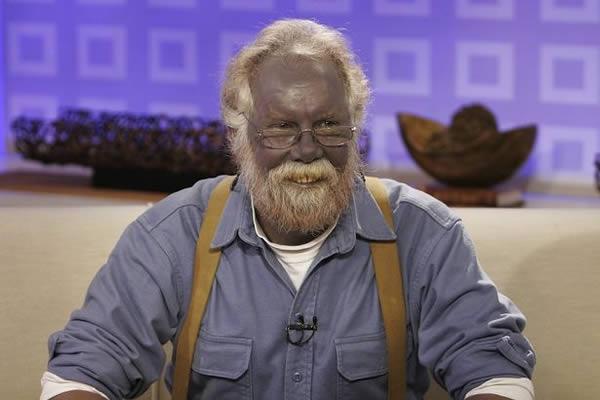 For 40 years, Paul Karason of Oregon was fair-skinned, with freckles and reddish-blond hair — until his skin turned a bright shade of blue.

Karason's blue skin is the result of a rare medical syndrome known as argyria, or silver poisoning. He began using silver as a form of alternative medicine, not knowing what might happen. 

In 1998, he saw an ad in a new-age magazine promising health and rejuvenation through colloidal silver. Karason sent away for a kit and, for a while, was drinking at least 10 ounces of silver a day. In those first months, he didn't notice a change in his skin color. But soon his face turned blue. Then, the rest of his body changed color as well.

Paul's reaction when he realized he'd turned all blue? "I hoped it would wear off!" But it didn't — argyria is permanent. Doctors suspect that it's not just his skin that's changed color — his internal organs are likely also blue.
