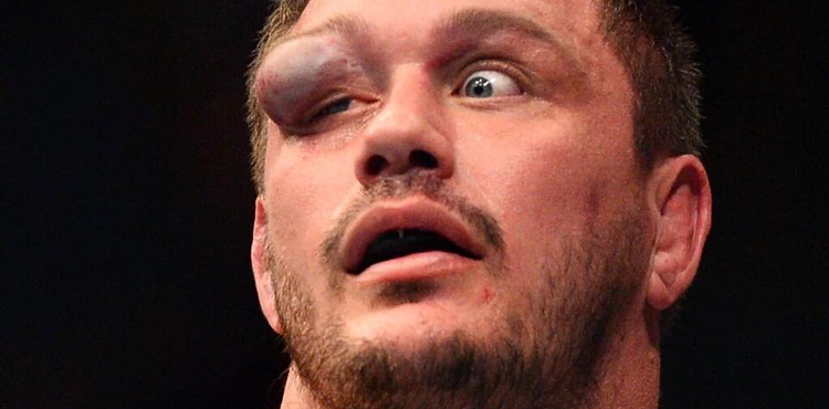 Matt Mitrione’s eye after two eye pokes and a couple punches from Travis Browne