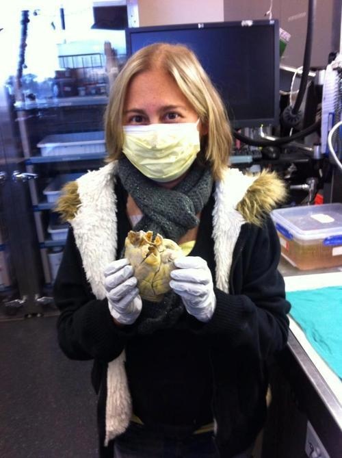 Penny is a heart transplant recipient holding her heart outside her body.