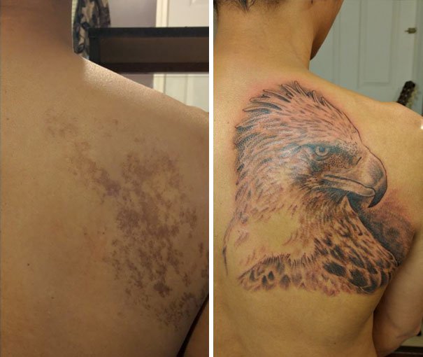 30 Unwanted birthmarks covered up with brilliant tattoos