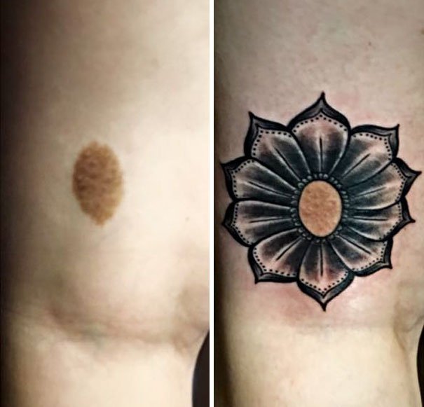 30 Unwanted birthmarks covered up with brilliant tattoos