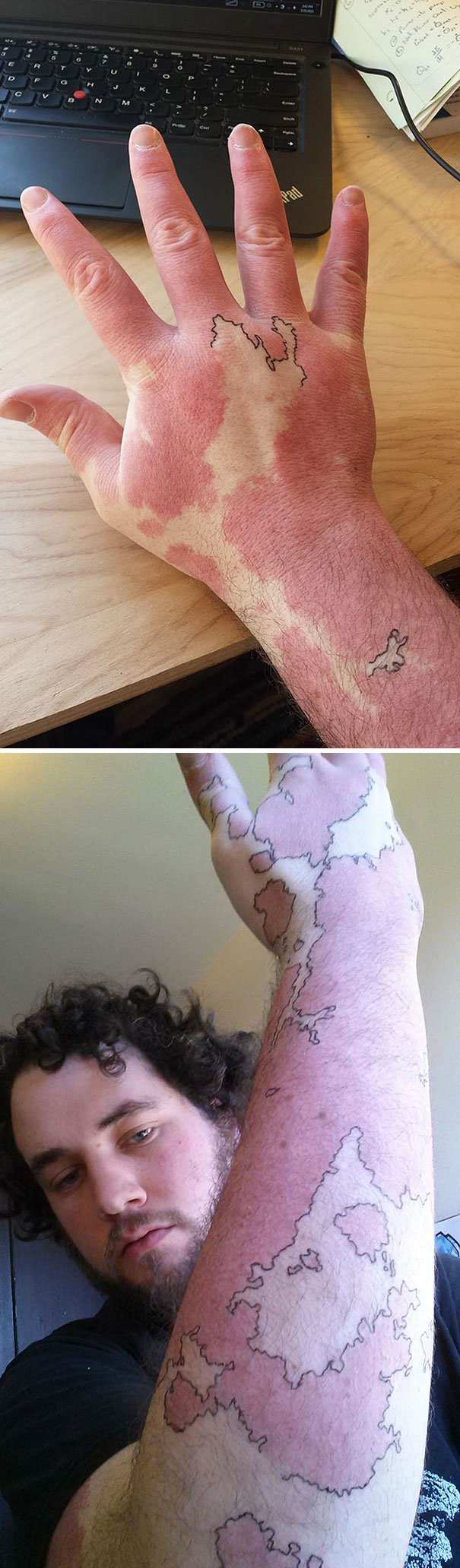 30 Unwanted birthmarks covered up with brilliant tattoos