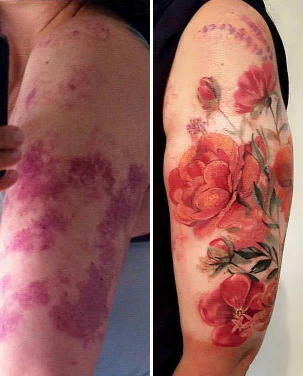 30 Unwanted birthmarks covered up with brilliant tattoos