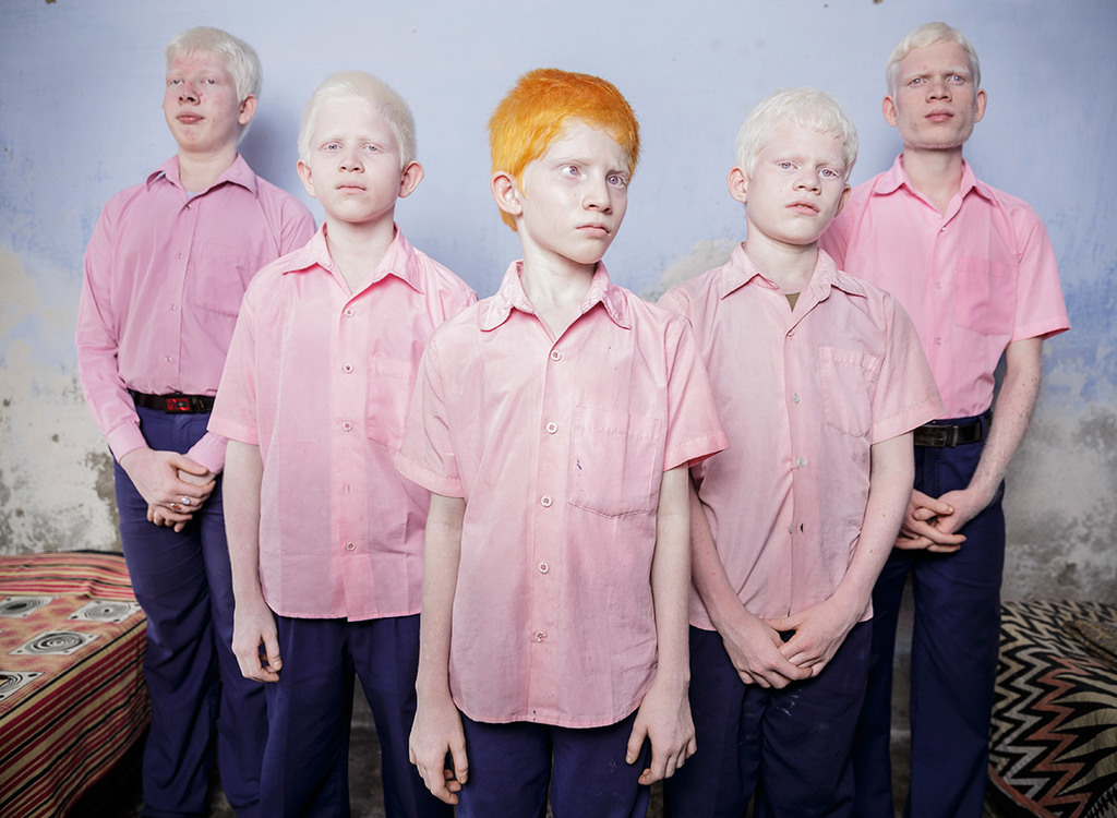 Blind albino boys in their boarding room at a mission school for the blind in West Bengal, India