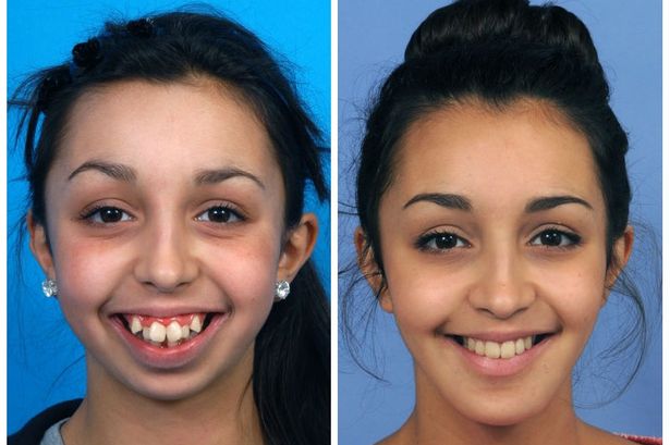 Woman Had Surgery For A Rare Facial Condition. Her Transformation Is Amazing!

Ellie was born with a rare condition which stopped her jawbones from growing properly. At first, her parents didn’t realize there was a problem, apart from the fact that her teeth were not aligned.
But when she went to have braces fitted to straighten her teeth when she was 14, orthodontist Joy Hickman realized her jaw had not grown since she was eight.
Over the next six years Hickman worked with a maxillofacial surgeon to transform Ellie’s looks.