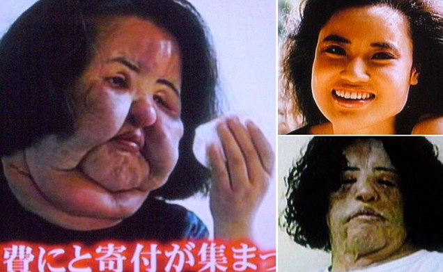 japanese plastic surgery gone wrong