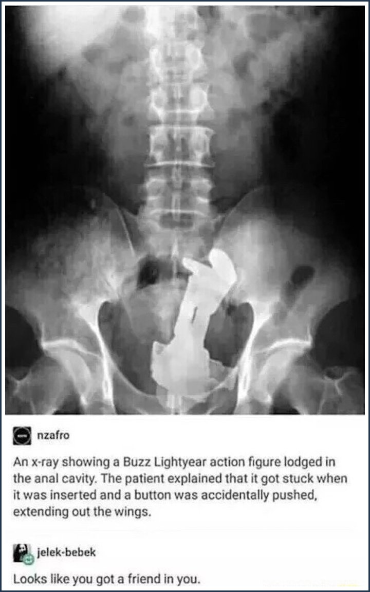 tumblr - funny x ray buzz lightyear - nzafro An xray showing a Buzz Lightyear action figure lodged in the anal cavity. The patient explained that it got stuck when it was inserted and a button was accidentally pushed, extending out the wings. jelekbebek L