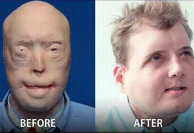 before and after face transplant - Before After