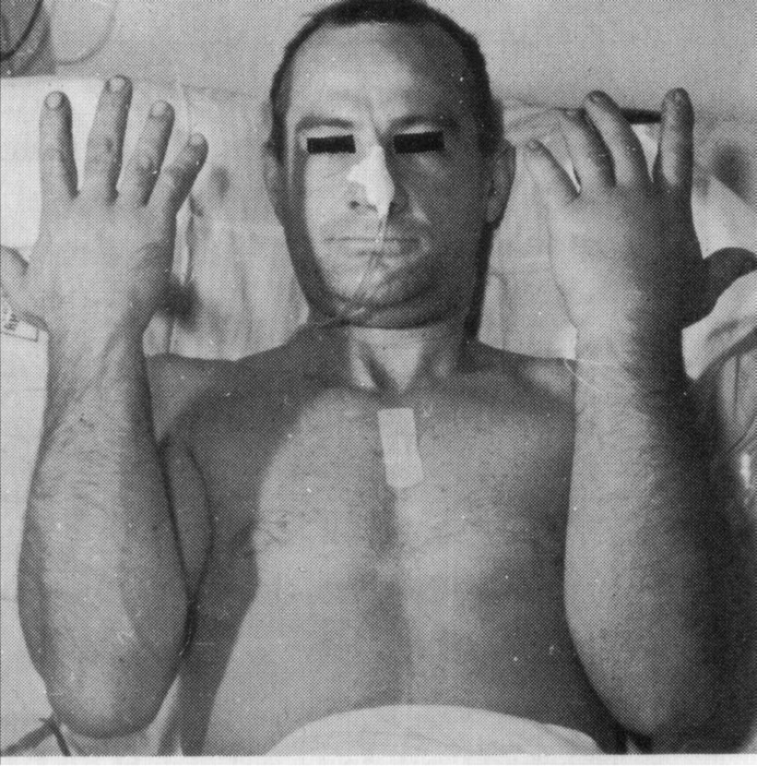 Man after receiving 40 Sieverts of radiation.. More than 1 Sievert of radiation will make you sick and may kill you, more than 3 will almost surely kill you.