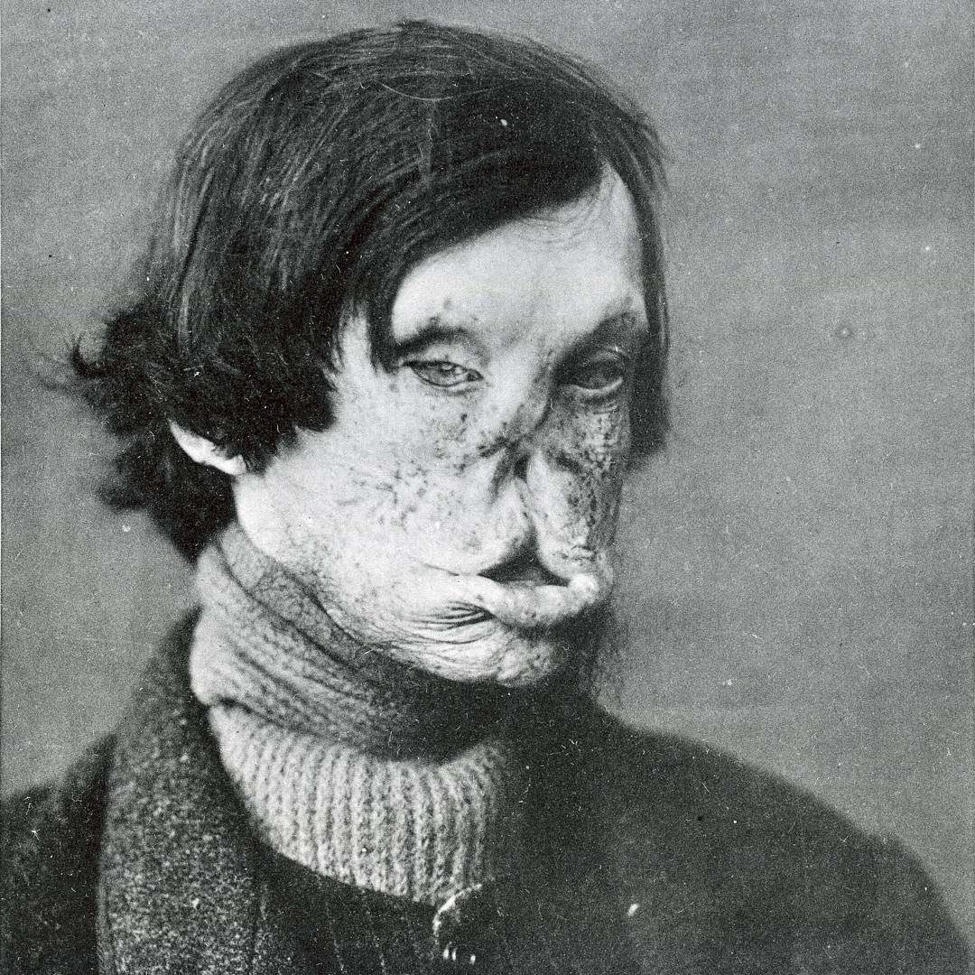 A Leprosy sufferer from 1895