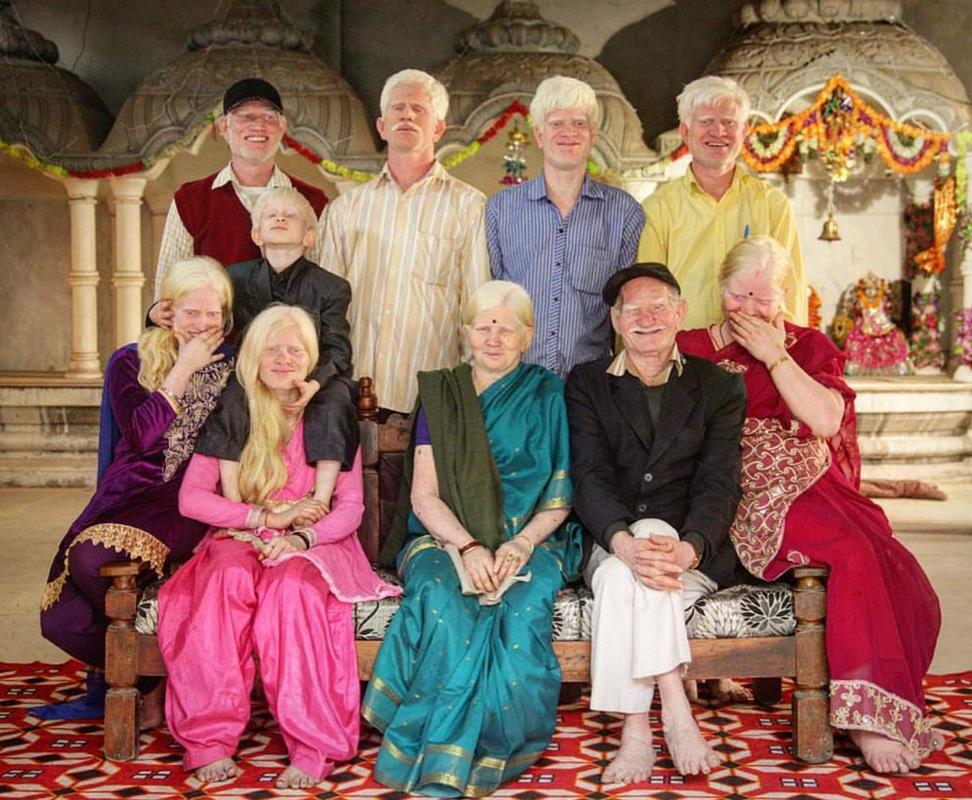 Three generations of an albino family in India