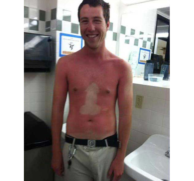 25 epic sunburns