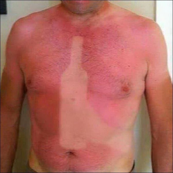 25 epic sunburns