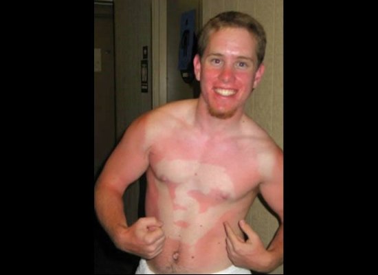 25 epic sunburns