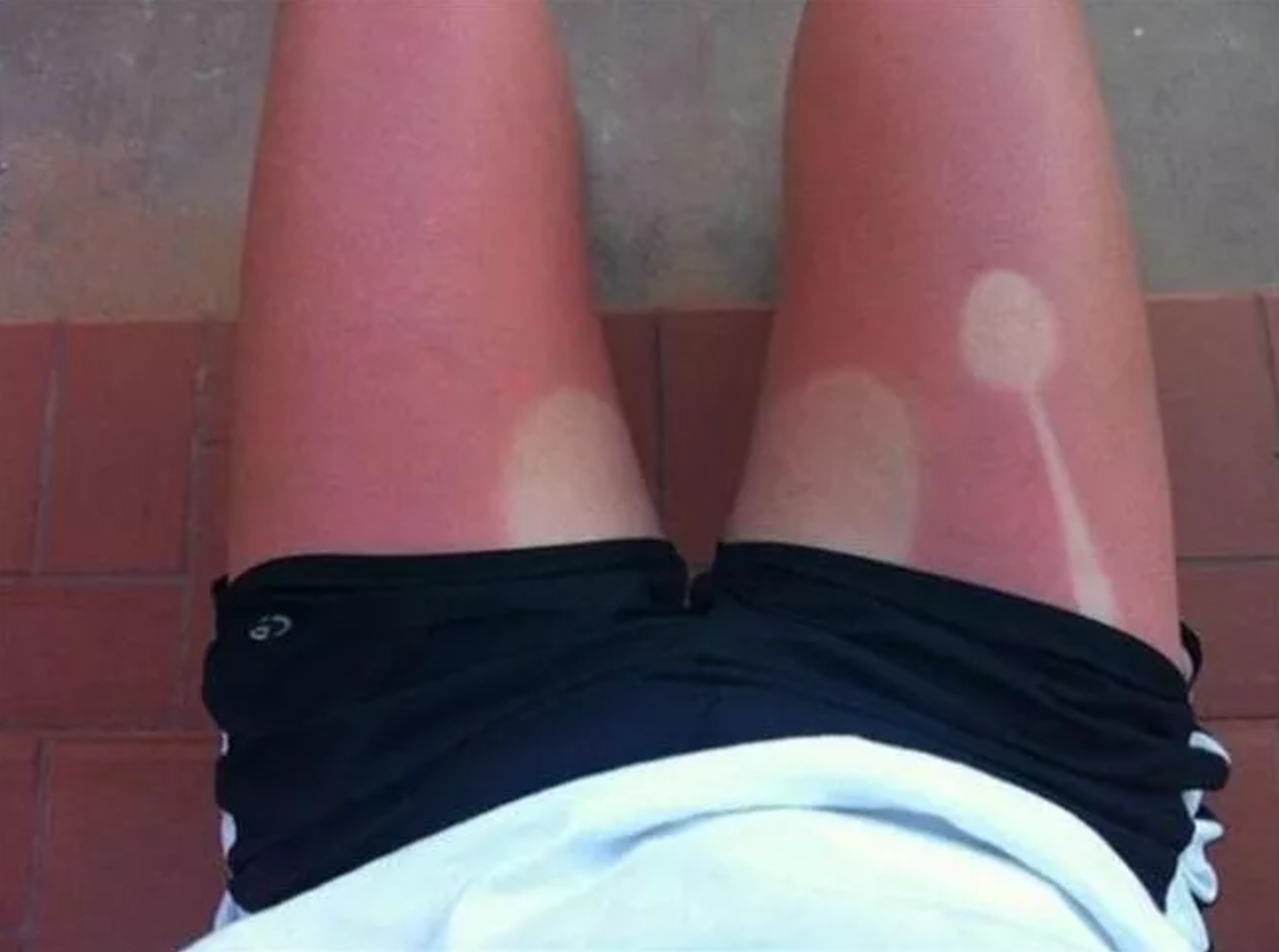 25 epic sunburns