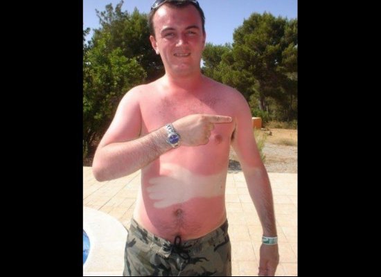 25 epic sunburns