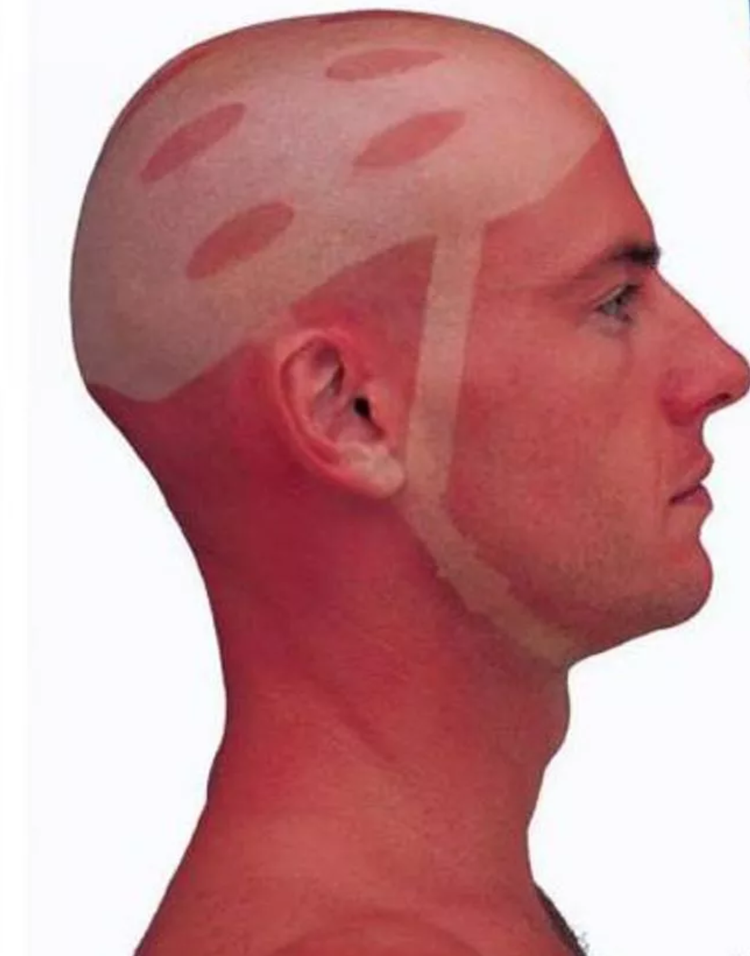 25 epic sunburns