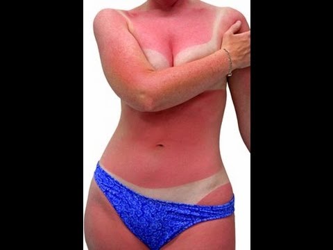 25 epic sunburns