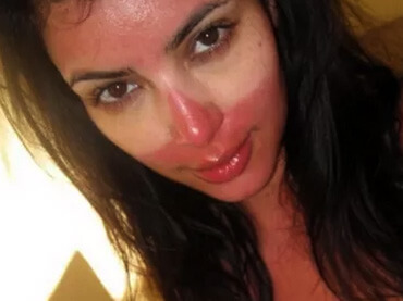 25 epic sunburns