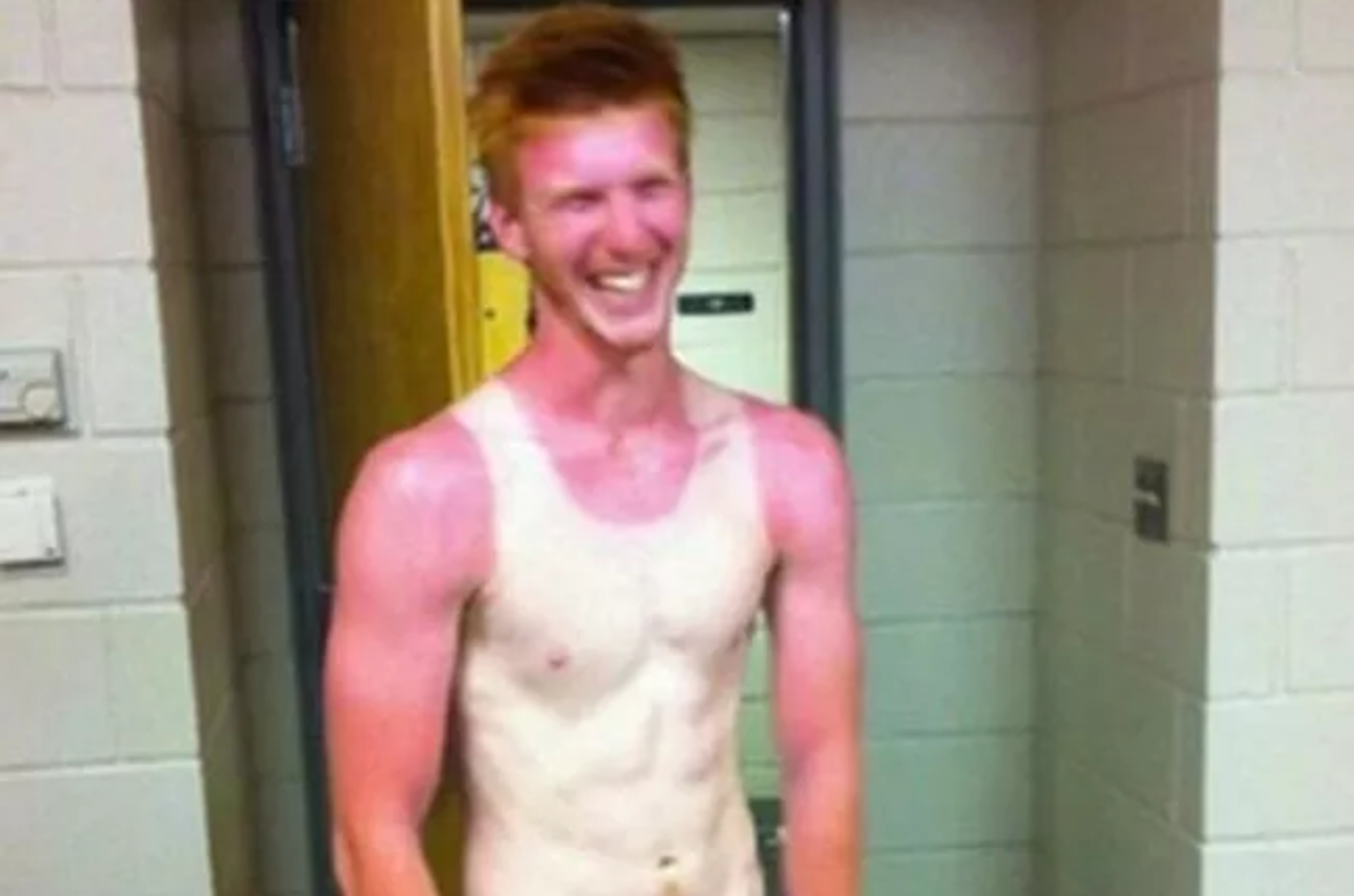 25 epic sunburns