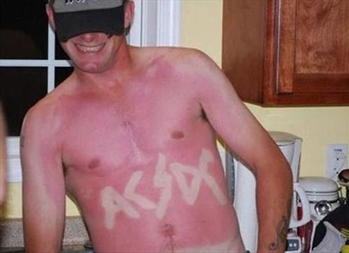 25 epic sunburns