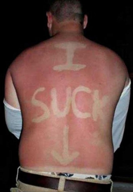 25 epic sunburns