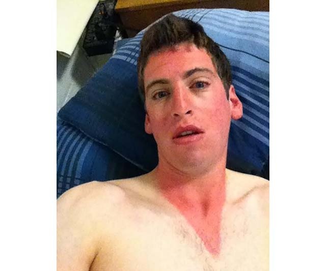 25 epic sunburns