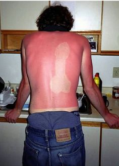 25 epic sunburns