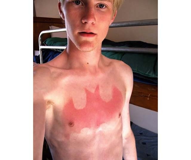 25 epic sunburns