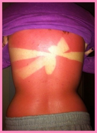 25 epic sunburns