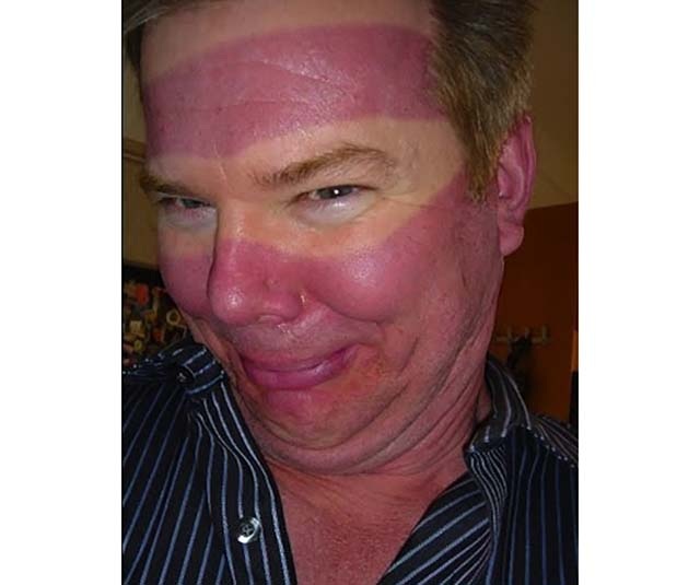 25 Epic Sunburns Facepalm Gallery Ebaums World