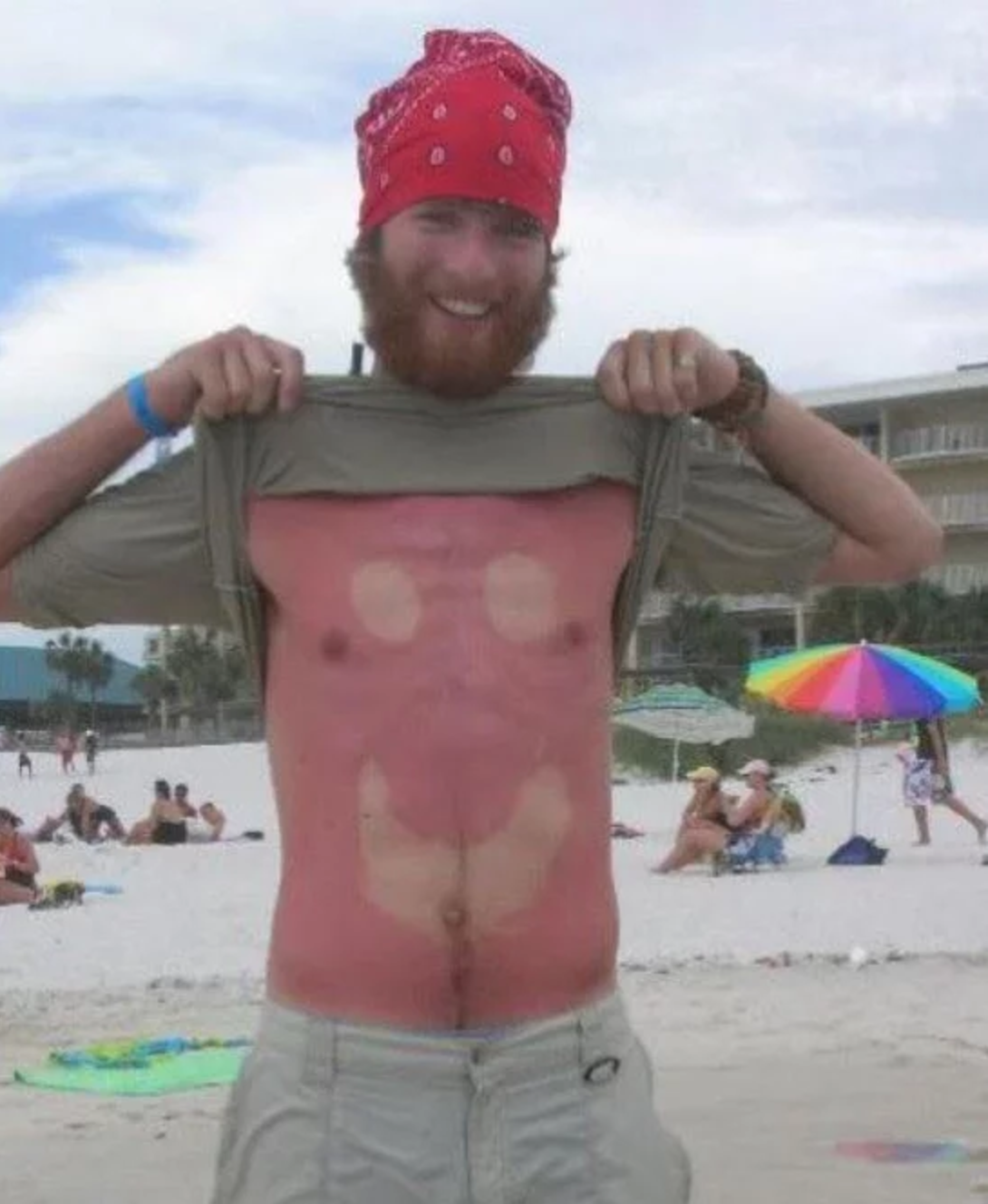 25 epic sunburns