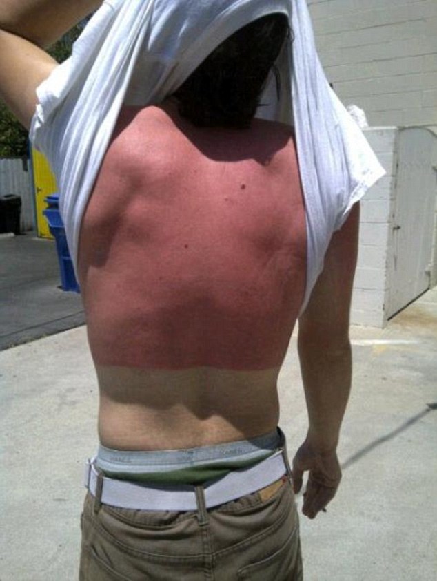 25 epic sunburns