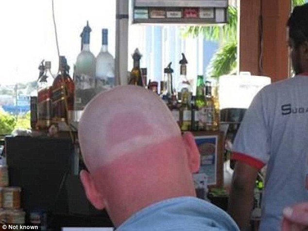 25 epic sunburns