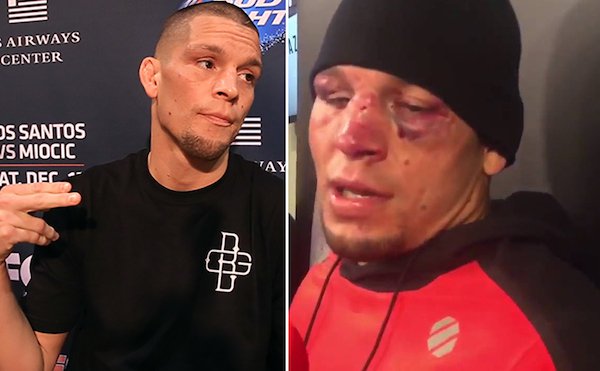 14 of the Most Brutal Before and After Pics of UFC Fighters