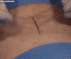 The future of stitches