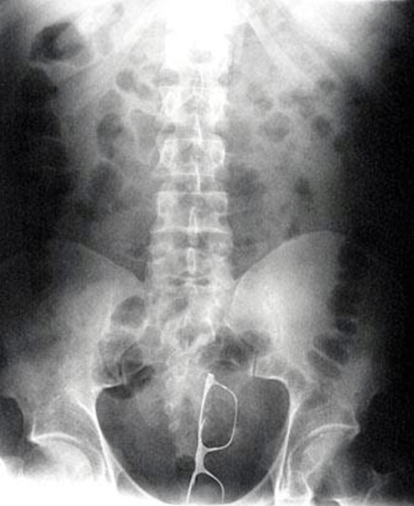 stuck up x rays