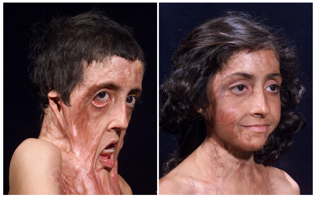 Before and after pictures of a burn victim facial reconstruction