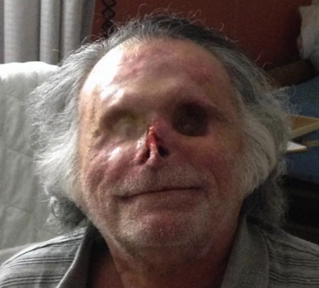 A recovered Ronald Poppo after his face was chewed off by an man on “bath salts” in 2012