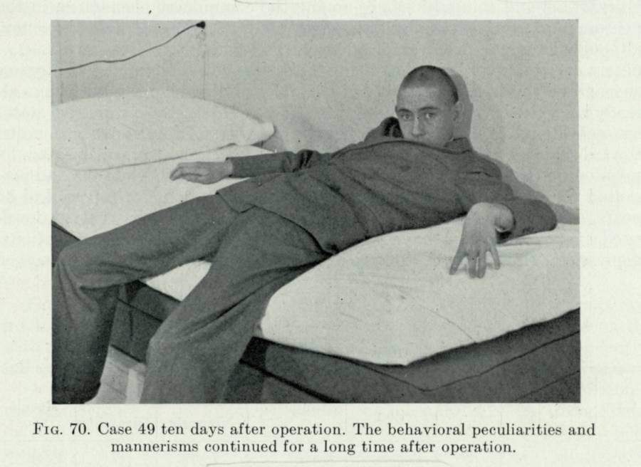 One of Walter Freeman’s lobotomy patients ten days after the procedure. 1942.