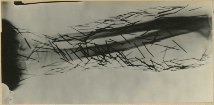 An x-ray of needles driven into the flesh by a self-harming patient.