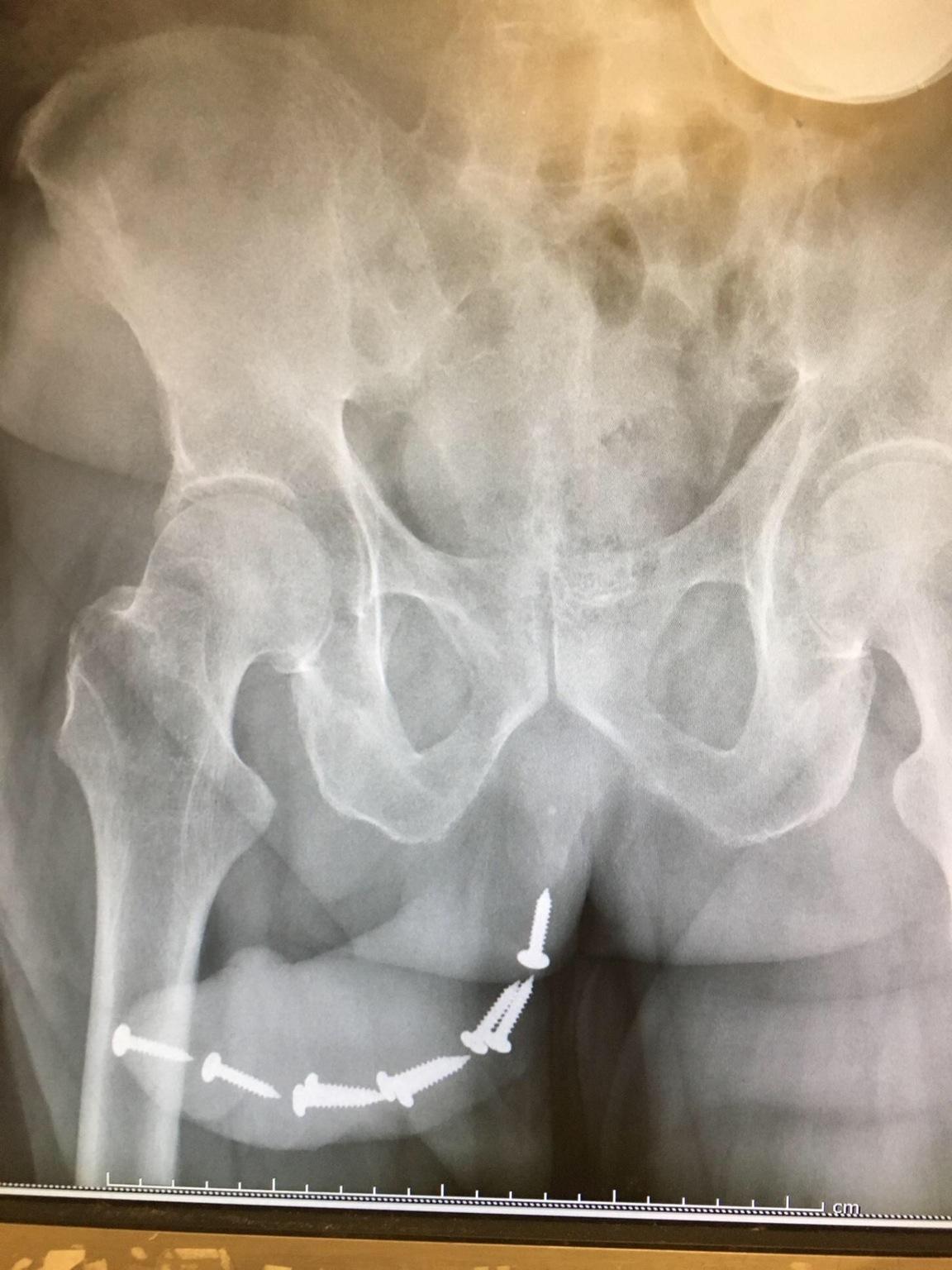 X-ray of angry woman who placed 7 screws into a man's urethra