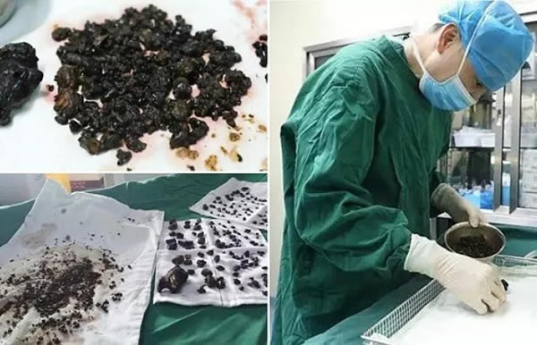Surgeons at Guanji Hospital, in Hezhou, China, recently spent six hours removing over 200 stones from a woman's gallbladder and liver, some of them the size of small eggs.

The patient, a 45-year-old known only as Ms. Chen, had apparently been experiencing abdominal pain for over a decade. When she first went to a hospital, an examination revealed several stones in her gallbladder and liver as the cause. Doctors advised her to undergo surgery and have them removed, but she was too scared to go under the knife. She only recently went to Guanji Hospital, when the pain became “unbearable.”

Dr. Quan Xuwei, one of the surgeons who operated, said that such a large number of stones was unusual, adding that it was probably caused by the woman's eating habits.